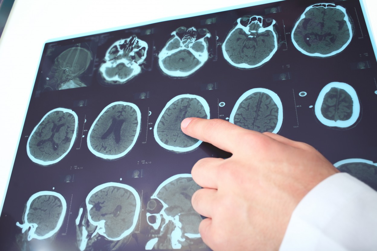 Diffusion MRI Shows Potential as Sensitive Measure of ALD Progression, Study Shows
