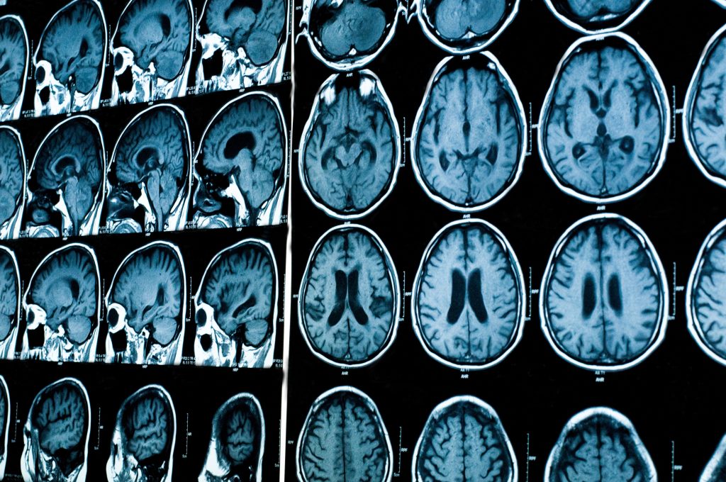 Ald Patients Without Mri Lesions Retain Cognitive Abilities, Study Says