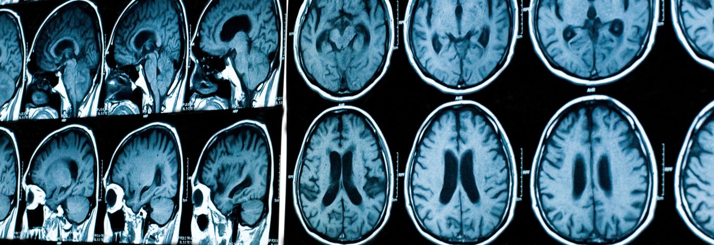Most ALD Patients Without MRI Lesions Retain Normal Cognitive Function, Study Suggests