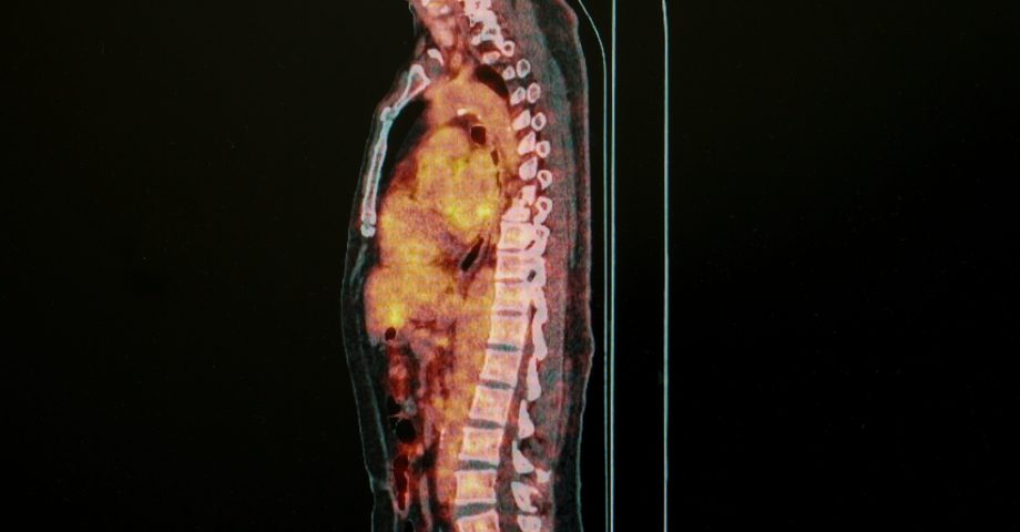 Spine’s Cross-Sectional Area May Capture Degree of Nerve Atrophy